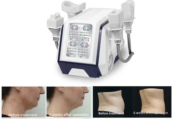 Máquina portátil 1000W do emagrecimento do corpo de 360 Cryolipolysis para a perda de peso ardente gorda